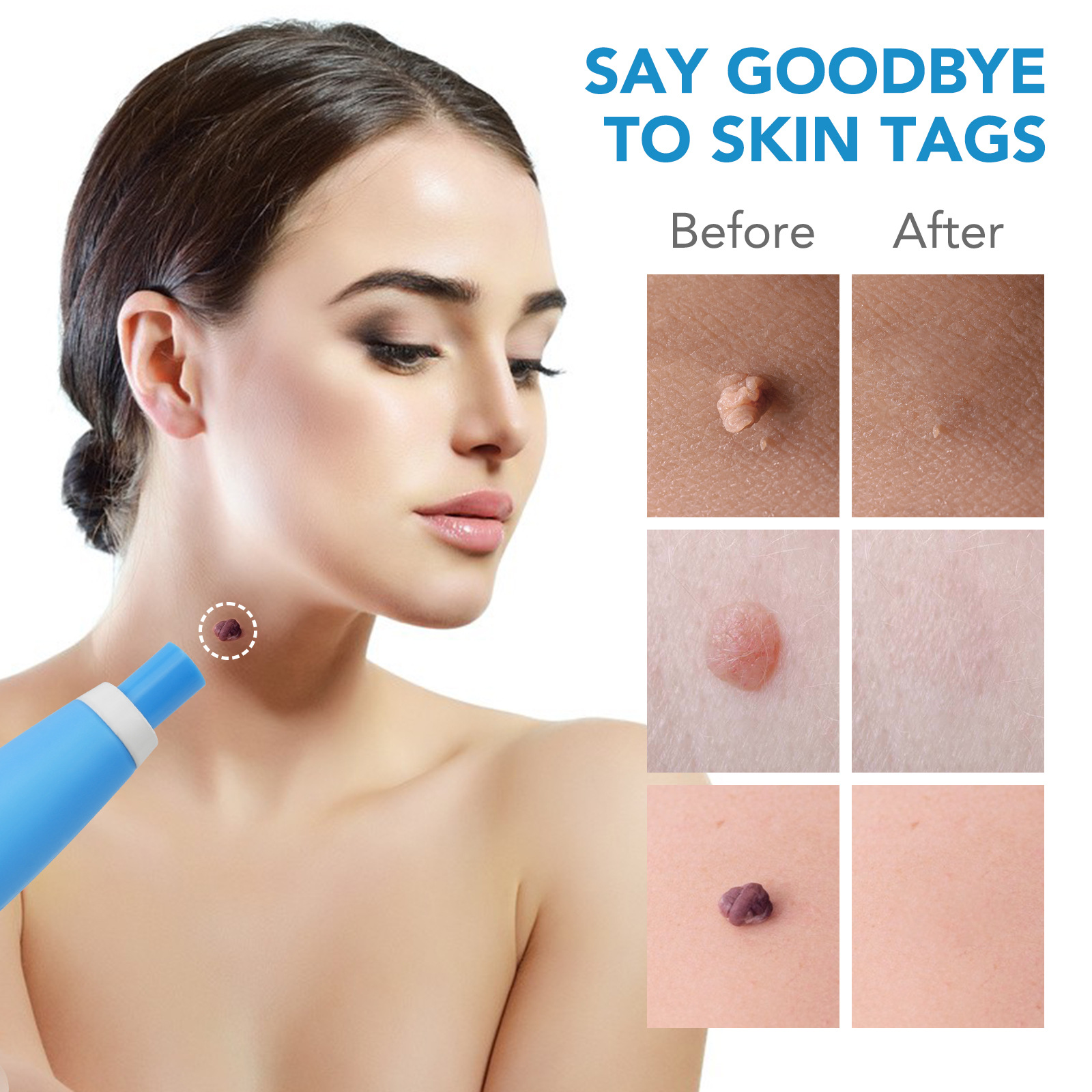 2 IN 1 Auto Skin Tag Remover K - Skincare Qv ulasan dan harga