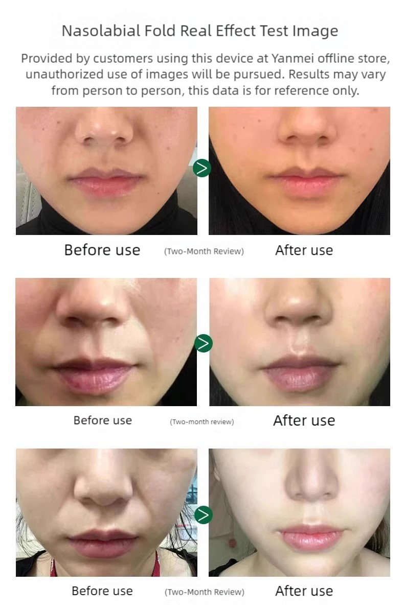 Multifunctional Radiofrequency - Skincare Hn ulasan dan harga