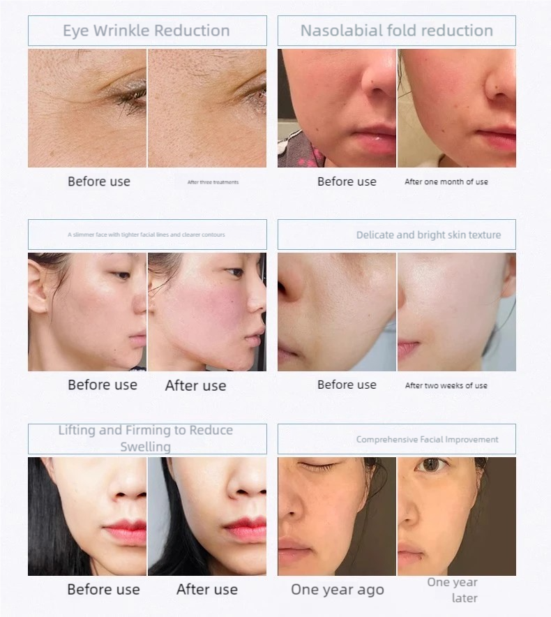 Multifunctional Radiofrequency - Skincare Hn ulasan dan harga